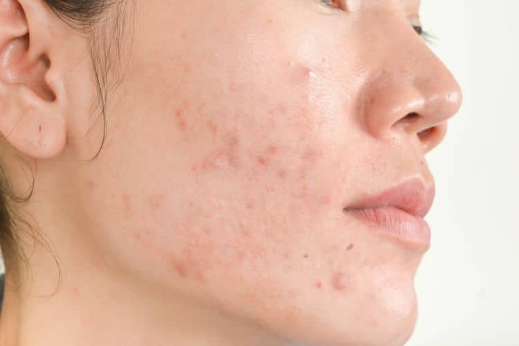 how-to-get-rid-of-acne-marks-once-for-all-gimzhacks